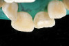 Fig 6. Placement of tilted
implants in existing native bone enables expedited therapy in the case of terminal dentitions.
Fig 5: Representative scenario involving advanced generalized periodontitis with marked bone
loss. Immediate placement (and loading) requires primary stability that cannot be achieved in the
residual tooth sockets of such cases. Alveolectomy and tilted implant placement in the residual
native bone is one approach to immediate implant therapy. In such cases, there is often insufficient
bone volume in zone 3 for implant placement. Fig 6: Panoramic radiographic evaluation following
final prosthesis delivery illustrates the use of tilted implants in zone 2, which was required
to achieve anterior-posterior distribution of implants to support molar function and permit the
intervening period of immediate provisionalization.