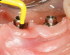 Fig 8. Tilted implant solutions for maxillary posterior partial edentulism. In the same manner that tilted implants can be used to
avoid the need for sinus grafting in full-arch implant prostheses, they can be used to avoid direct or indirect sinus grafting when insufficient posterior
maxillary bone volume challenges a fixed dental prosthesis implant restoration. Fig 7: Software planning for implant placement is shown with
tilting of the distal implant along the anterior wall of the maxillary sinus where there is insufficient bone in zone 3. Fig 8: Postoperative radiograph
of the implants and abutments reveals the angulation of the implant resolved by the CAD/CAM abutment. Fig 9: Final radiograph of the implant
prosthesis following restorations demonstrates the inclusion of a tooth in the molar position without sinus grafting.