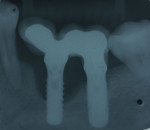 Figure 2 Radiographic assay of implants, demonstrating advanced supporting bone loss.