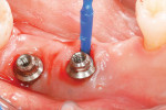 Figure 3 Nonsurgical debridement with microbrush.