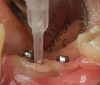 Fig 13. Short implants used to avoid grafting. Fig 13: Occlusal view of a full-arch fixed dental prosthesis supported by five endosseous
implants placed. Fig 14: The left distal implant was tilted to support the left molar unit of the prosthesis. Fig 15: A 6 mm x 5.4 mm implant
was used to support the right molar unit of the prosthesis. The strategic application of nongrafted solutions helped accelerate treatment and
reduce treatment costs.