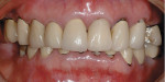 Figure 1. Frontal view of the patient’s preoperative dentition in maximum intercuspal position.