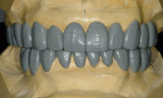 Figure 5. Frontal view of diagnostic wax-up.