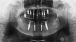 Figure 10. Panoramic radiograph revealed that transitional provisional restorations were supported by implants and tooth No. 2.