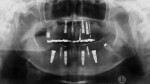 Figure 7. Panoramic radiograph showed the first phase of implants placed and long-term provisional restorations supported by remaining teeth.