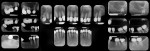 Figure 2. Preoperative full-mouth periapical radiographs.