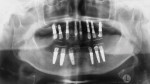 Figure 12. Panoramic radiograph indicated that provisional restorations were fully supported by implants.