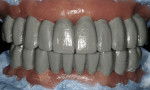 Figure 11. Frontal view of the full-contour wax-up. Angle Class I canine position was achieved after the maxillary incisors were repositioned lingually (4 mm horizontally).