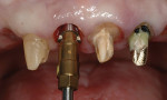 Figure 6. Implant placement surgery on No. 8 site.