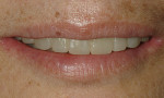 Figure 13 and Figure 14. Patient’s frontal and lateral views of smile with provisional restorations supported by implants. A more esthetic display of the teeth was achieved.