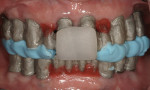Figure 17. Frontal view of maxillary/mandibular relationship records with metal substructures trying-in.