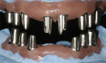 Figure 15. Frontal view of titanium-milled individual abutments in casts.