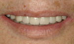 Figure 19. Frontal view of postoperative smile.