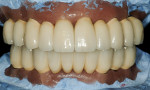Figure 18. Frontal view of definitive restorations in casts.