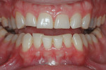 Figure 1. Severe attrition of tooth structure was visible throughout. The patient’s age combined with the functional risk established the functional prognosis as guarded.