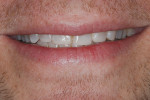 Figure 7. A composite mock-up displayed an incisal plane that was level in the face.