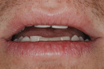 Figure 6. Use of a direct composite mock-up provided an opportunity for the patient to see different lengths of the maxillary central incisors and indicate his preference.
