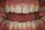 Figure 10. A new vertical dimension was established by adding to the mandibular cusp tips.