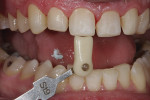 Figure 11. Conservative preparations were finished entirely in enamel.