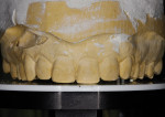 Figure 9. The length of tooth No. 9 was chosen as the desired incisal edge position, and the platform was set at this position.