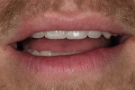 Figure 14. Post-treatment image illustrates the fulfillment of the patient’s desire for more tooth display.
