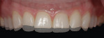 Figure 18. A level and harmonious maxillary occlusal plane was achieved primarily with an additive restorative approach.