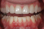 Figure 13. View of teeth slightly apart showing the refinement of the mandibular cusps completed after the maxillary restorations were seated.