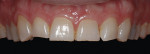 Figure 17. View of the maxillary arch displays the aberrant occlusal plane before treatment.