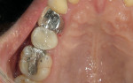 Figure 8  defective amalgam restoration with fractured cusp restored with packable RBC