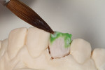 Figure 10 - Dentin and enamel opal colors.