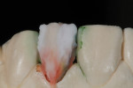 Figure 15 - Enamel 59 was applied all the way to the gingival.