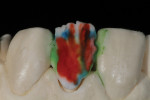 Figure 16 - Enamel 59 was applied all the way to the gingival.