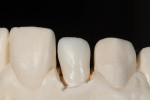 Figure 18 - Build-up began on tooth No. 7.