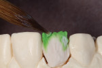 Figure 20 - Regular dentin A1 and translucency modifier were applied.