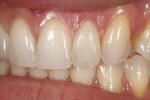 Figure 47 - A final check-balance of the teeth.