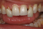 Figure 48 - A final check-balance of the teeth.