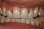 Figure 49 - A final check-balance of the teeth.