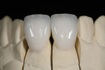 Figure 7 Final zirconia crowns on the master cast.