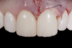 Figure 4 Provisional
acrylic crowns to determine and idealize the prospective tooth proportions, lengths,
and position of the incisal edges.