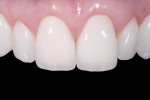 Figure 12 Intraoral postoperative situation of zirconia crowns on
maxillary central incisors.