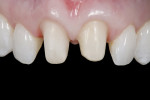 Figure 6 Crown preparations were finalized after 6 months of soft-tissue healing.