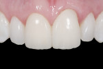 Figure 5 A connective-tissue graft was placed to create more
even gingival margins and a “cushion” of increased soft-tissue thickness to limit further gingival
recession.