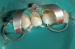 Figure 3  Placement of rubber dam with application of cervical clamp on central incisor for extra retraction.