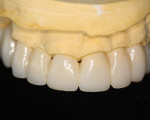 Figure 6 Finish, polish, and deliver the provisional for seating in the patient’s mouth.
