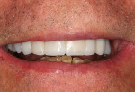 Figure 9 Finish, polish, and deliver the provisional for seating in the patient’s mouth.
