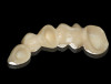 (2.) Full-contoured monolithic zirconia crown (left) and monolithic zirconia crown with facial cutback design (right) after milling.