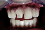 Figure 5  Finish line at the crest of the free gingiva.