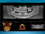 Figure 2  CT scans and tomography were used for treatment planning.