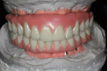 Figure 4 A new wax-up was created to the patient’s specifications.