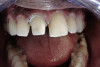 Fig 9. Mandibular arch with shallow vestibular and floor-of-the-mouth depth.